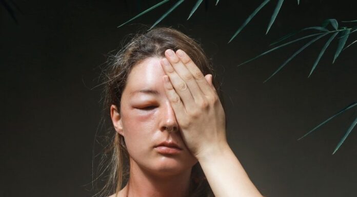 Darázscsípés enyhítése darázscsípés enyhítése